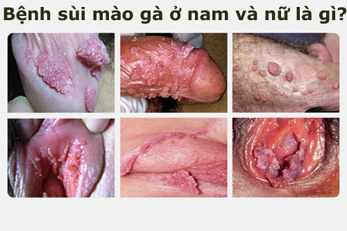 Bệnh sùi mào gà ở nam và nữ là gì? nguyên nhân và cách chữa
