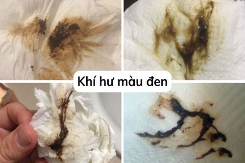 12 cách chữa khí hư màu đen hiệu quả tại nhà