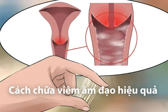 Cách chữa viêm âm đạo hiệu quả