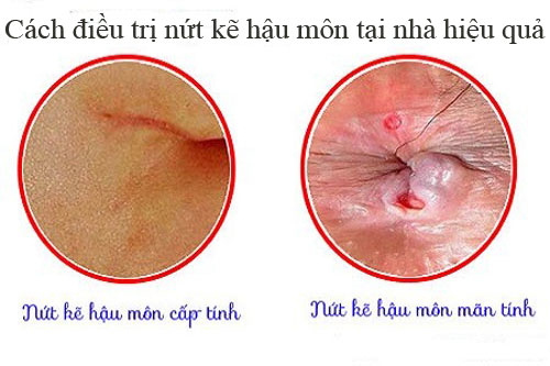 Cách điều trị nứt kẽ hậu môn tại nhà hiệu quả