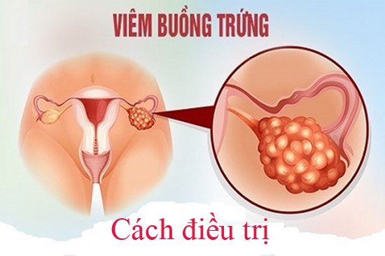 Cách điều trị viêm buồng trứng tại nhà hiệu quả
