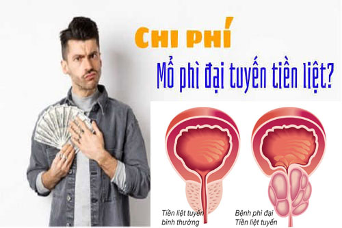 Chi phí mổ phì đại tuyến tiền liệt hết bao nhiêu tiền