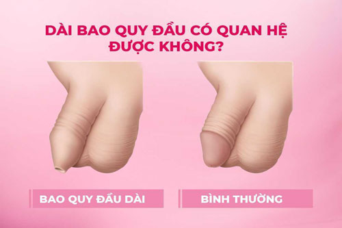 Dài bao quy đầu có quan hệ được không?