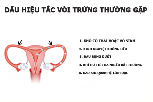 10 Dấu hiệu tắc vòi trứng thường gặp nhất