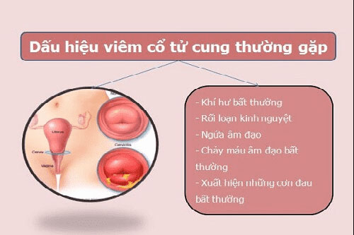 Dấu hiệu viêm cổ tử cung thường gặp nhất