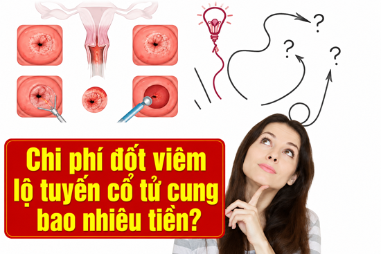 Chi phí đốt viêm lộ tuyến cổ tử cung hết bao nhiêu tiền Chi phí đốt viêm lộ tuyến cổ tử cung hết bao nhiêu tiền