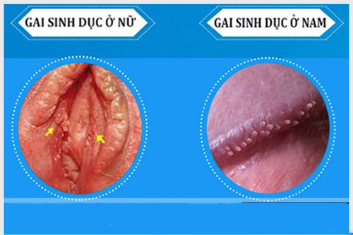 Gai sinh dục