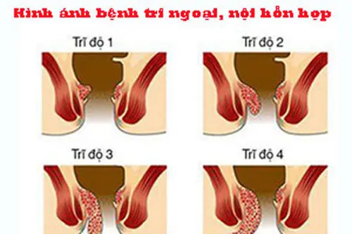 Hình ảnh bệnh trĩ