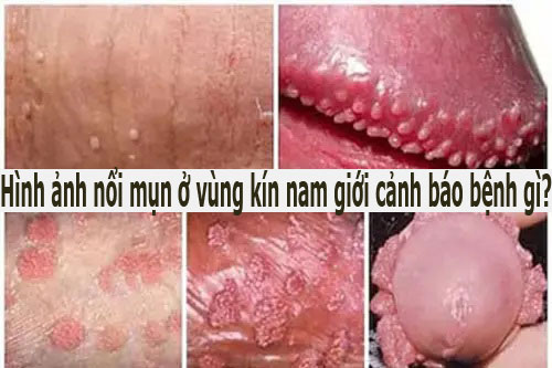 Hình ảnh nổi mụn ở vùng kín nam