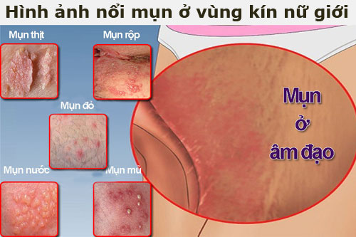 Hình ảnh nổi mụn ở vùng kín nữ giới