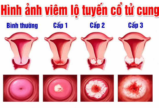 Hình ảnh viêm lộ tuyến cổ tử cung cấp độ 1, 2, 3, 4 từng giai đoạn