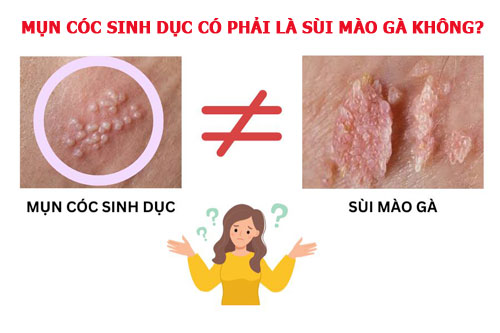 Mụn cóc sinh dục có phải là sùi mào gà không?