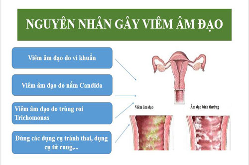 Nguyên nhân viêm âm đạo thường gặp nhất và cách chữa