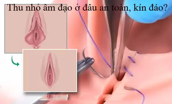 Thu nhỏ âm đạo ở đâu? Top 10 địa chỉ uy tín tại Hà Nội