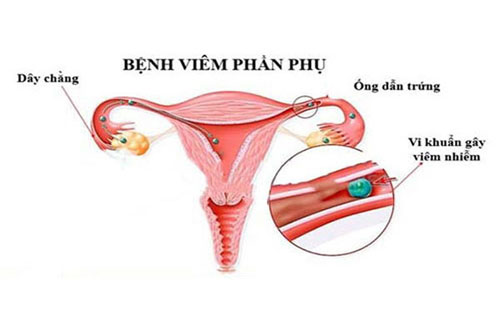 Viêm phần phụ là gì? Triệu chứng và cách chữa