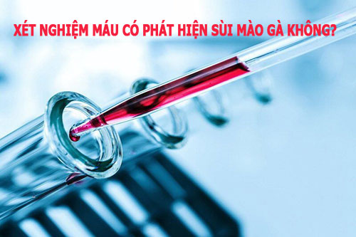 Xét nghiệm máu có phát hiện sùi mào gà không