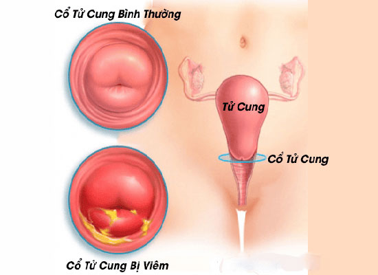 Bệnh viêm cổ tử cung là gì?