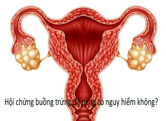 Hội chứng buồng trứng đa nang có nguy hiểm không?