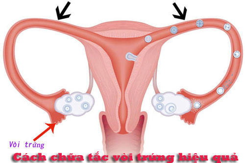 10 Cách chữa tắc vòi trứng hiệu quả tại nhà