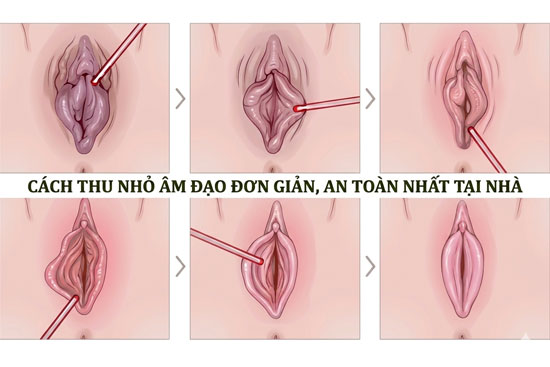11 cách thu nhỏ âm đạo đơn giản hiệu quả tại nhà