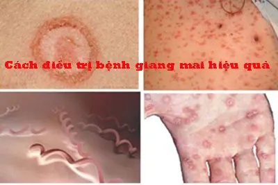12 Cách chữa bệnh giang mai tại nhà hiệu quả