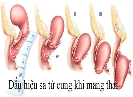 dấu hiệu sa tử cung khi mang thai