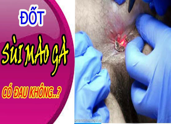 Đốt sùi mào gà có đau không