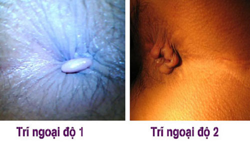 Hình ảnh bị bệnh trĩ ngoại