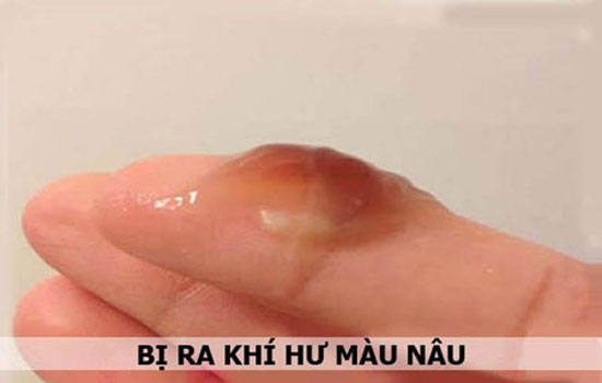 12 Nguyên nhân dẫn đến khí hư màu nâu