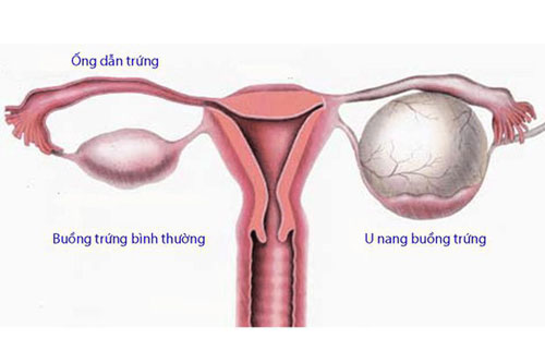 Tìm hiểu về u nang buồng trứng Tìm hiểu về u nang buồng trứng