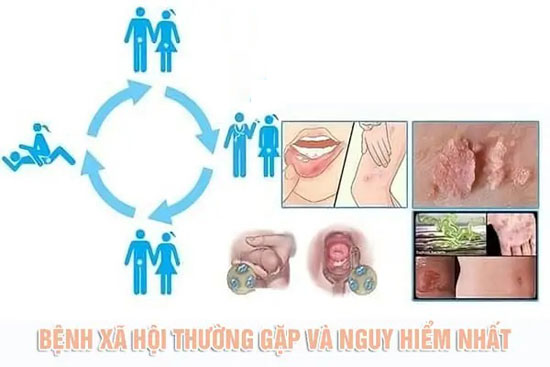10 Bệnh xã hội thường gặp và cách chữa