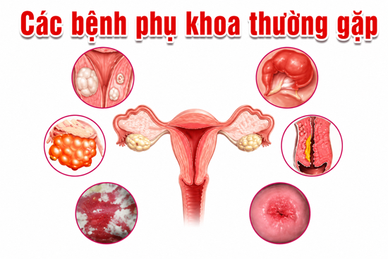 11 Bệnh phụ khoa thường gặp ở phụ nữ giới