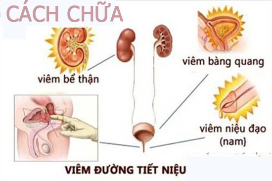 Cách chữa viêm đường tiết niệu đơn giản hiệu quả tại nhà