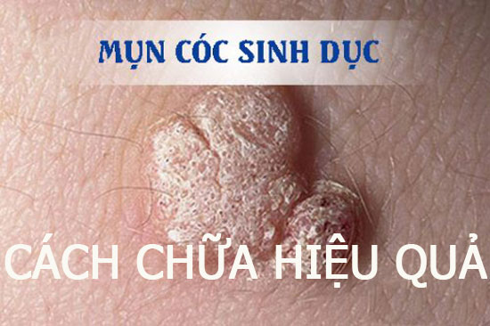 Cách chữa mụn cóc sinh dục 