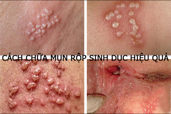 Cách chữa mụn rộp sinh dục