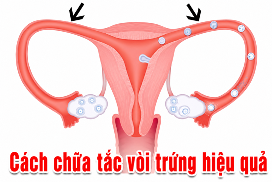11 Cách chữa tắc vòi trứng hiệu quả tại nhà