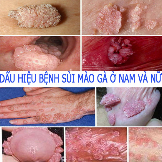 12 dấu hiệu bệnh sùi mào gà ở nam và nữ thường gặp