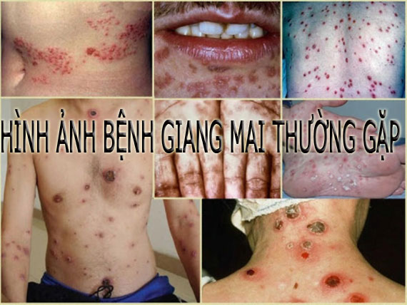 10 Hình ảnh bệnh giang mai ở nữ và nam thường gặp