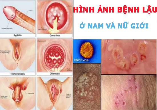 10 hình ảnh bệnh lậu ở nữ giới và nam giới thường gặp