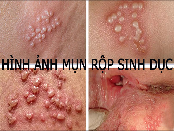 Hình ảnh mụn rộp sinh dục