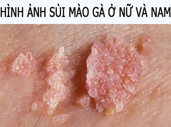 10 Hình ảnh sùi mào gà ở nữ và nam thường gặp