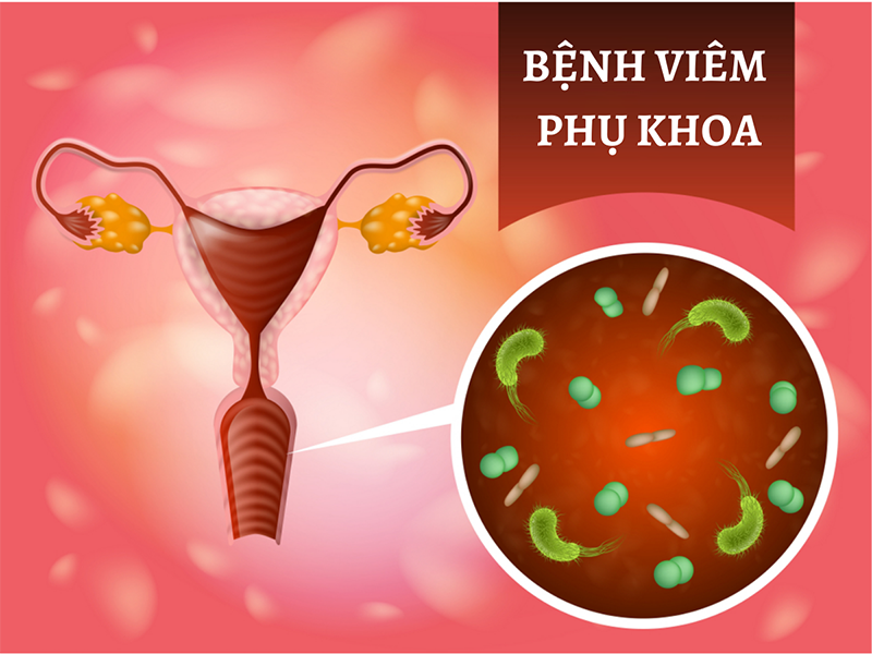 Viêm phụ khoa là gì? Nguyên nhân, triệu chứng và cách chữa