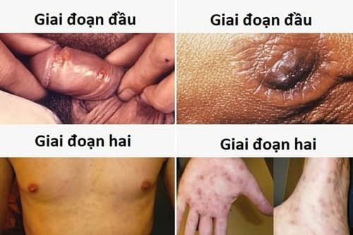 Bệnh giang mai qua các giai đoạn Bệnh giang mai qua các giai đoạn