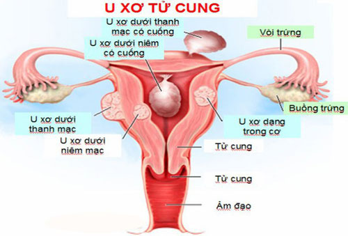 Bệnh u xơ tử cung có nguy hiểm không