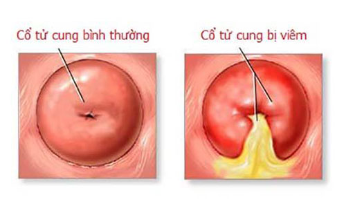 Bệnh viêm cổ tử cung