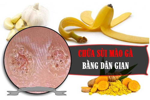 Cách chữa bệnh sùi mào gà