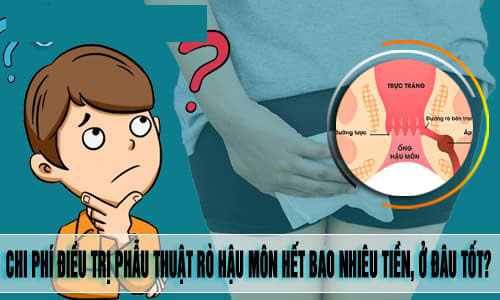 Chi phí phẫu thuật rò hậu môn hết bao nhiêu tiền năm 2026