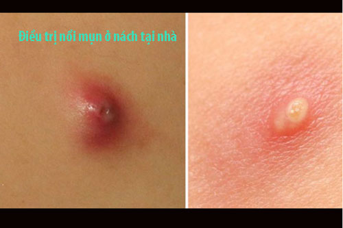 Điều trị nổi mụn ở nách tại nhà