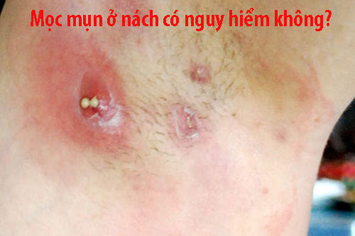 Mọc mụn ở nách có nguy hiểm không