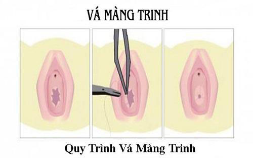 Chi phí vá màng trinh hết bao nhiêu tiền